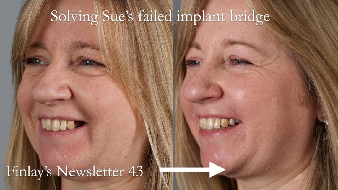 Solving Sue's failed implants with metal based RPD - full protocol Newsletter 43