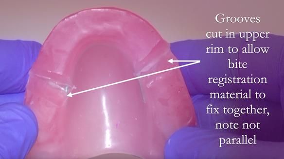 Newsletter 53 showing the making and fitting of ultra life-like dentures for Valena