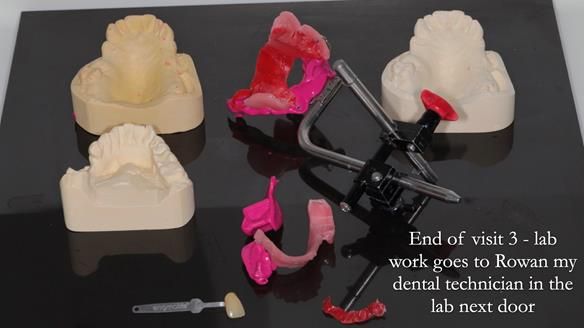 Finlay's Newsletter 60 Sylvia's upper Kennedy Class 2 Mod 1 metal based upper RPD