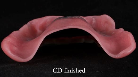 Finlay's Newsletter 62 provision of extractions and metal based complete dentures for Rafique