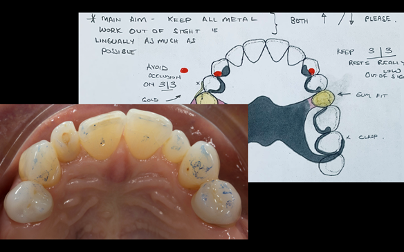 Figure 54 Preparation of rest seats in the upper canines so that the rests on the canines do not prop open the bite - maintaining ICP contacts on the natural upper and lower teeth.