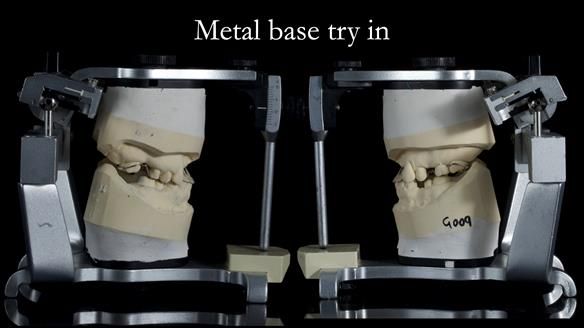 Newsletter 81 - Pam’s Story — how a partial denture changed her life (+ live walkthrough this Thursday)