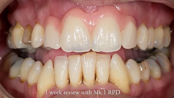Finlay's Newsletter 63 Case study provision of metal based Scandinavian RPD - functional 10 years on