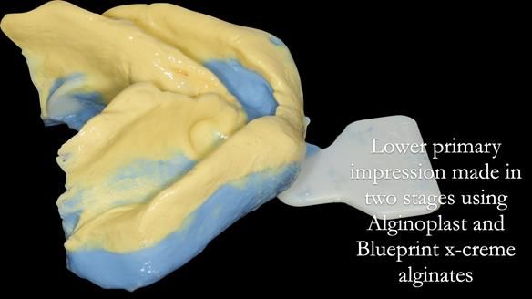 Newsletter 53 showing the making and fitting of ultra life-like dentures for Valena