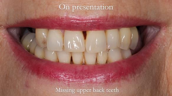 Newsletter 56 showing the making and fitting of a bilateral free end saddle upper removable partial denture (RPD) for patient with pemphigus