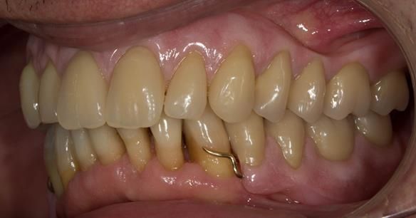 Figure 117 Mk 2 finished dentures fitted with 0.9 mm wrought gold clasps on LR4 and LL3