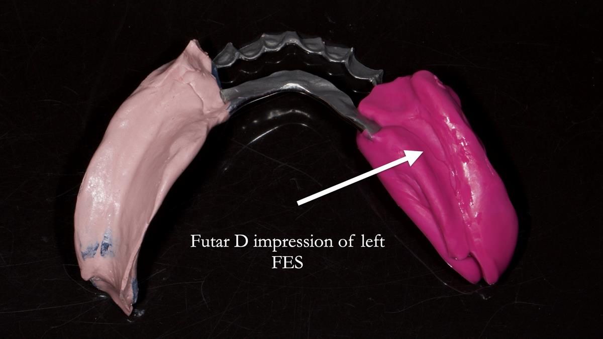 Newsletter 87 – Father Peter: A Partial Denture that needed Minor Miracle