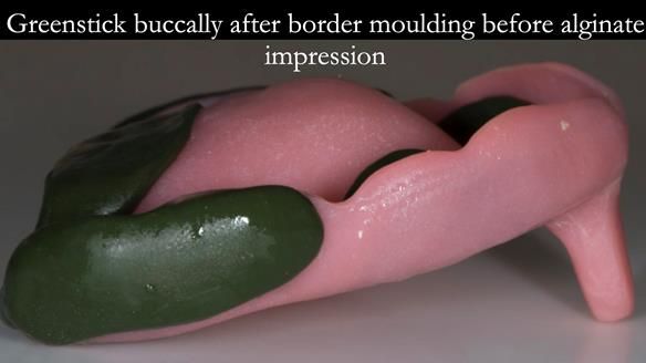 Newsletter 75: Marion’s case - Step-by-step complete denture workflow