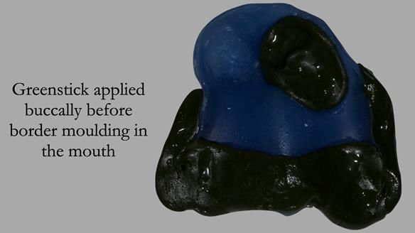 Newsletter 55 Provision of metal based partial dentures for Zephyrine with a repaired cleft lip and palate