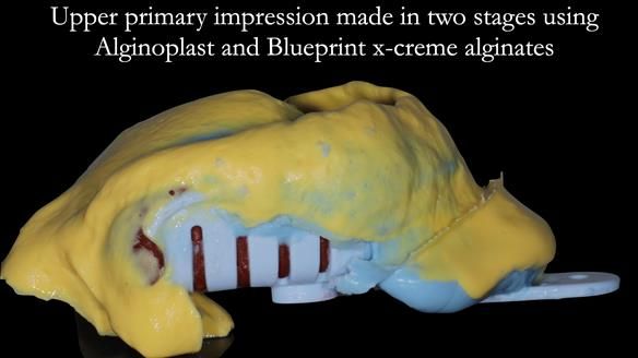 Newsletter 56 showing the making and fitting of a bilateral free end saddle upper removable partial denture (RPD) for patient with pemphigus
