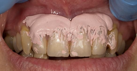 Figure 46 1 month after extractions - Immediate denture laboratory reline - part 1 with Zinc Oxide impression material