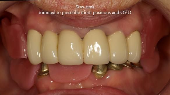 Newsletter 76: Jackie’s case – Telescopic overdenture & precision RPD (the tricky truth!)