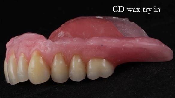 Finlay's Newsletter 62 provision of extractions and metal based complete dentures for Rafique