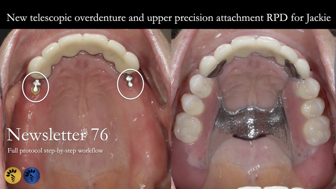 Precision attachments, telescopic crowns