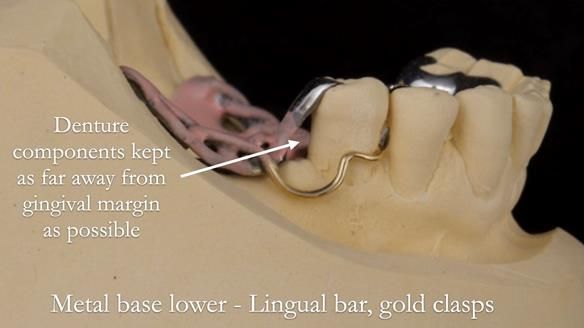 Solving Linda’s Failed “All on 4” implant bridges - full protocol Newsletter 42
