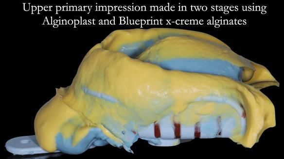Newsletter 56 showing the making and fitting of a bilateral free end saddle upper removable partial denture (RPD) for patient with pemphigus