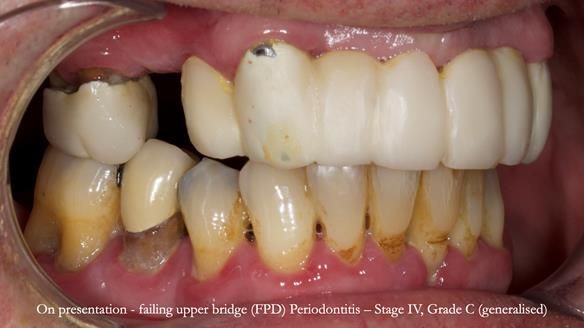 Newsletter 77: Jeremy’s case – immediate complete upper denture