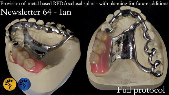 Finlay's Newsletter 64 case study - provision of a Kennedy class 2 metal based Scandinavian RPD for Ian
