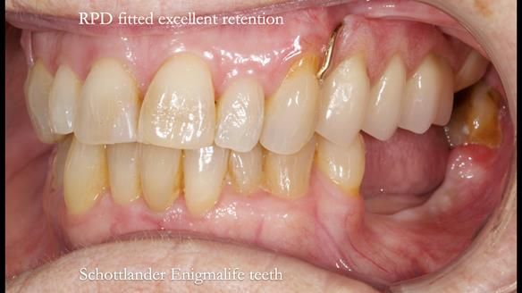 Finlay's Newsletter 60 Sylvia's upper Kennedy Class 2 Mod 1 metal based upper RPD