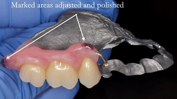 Finlay's Newsletter 64 case study - provision of a Kennedy class 2 metal based Scandinavian RPD for Ian