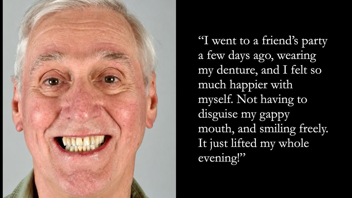 Newsletter 89 – Simon: A Challenging Kennedy Class II Division 1 Upper CoCr Partial Denture with a High Smile Line