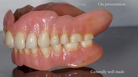 Newsletter 78: What do Clark Gable and a Locator® overdenture have in common?