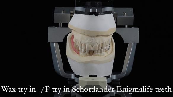 Newsletter 54 case presentation upper complete denture and lower Scandinavian designed hygienic partial denture for David