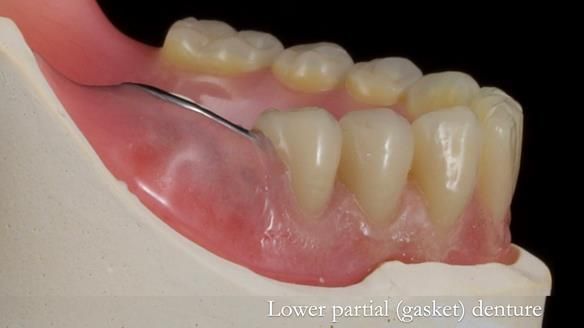 Newsletter 82 Mary - A complete upper and a one-tooth gasket denture