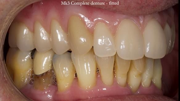 Newsletter 77: Jeremy’s case – immediate complete upper denture