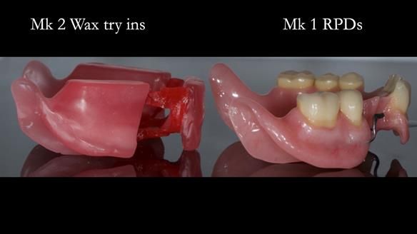 Finlay's Case Study Newsletter 40 - Immediate Mk 1 RPD to Definitive Mk 2 RPD - full protocol