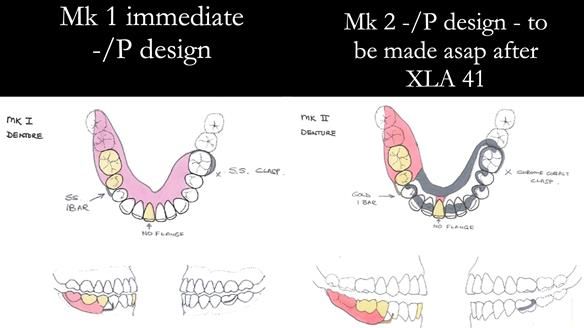 Newsletter 54 case presentation upper complete denture and lower Scandinavian designed hygienic partial denture for David
