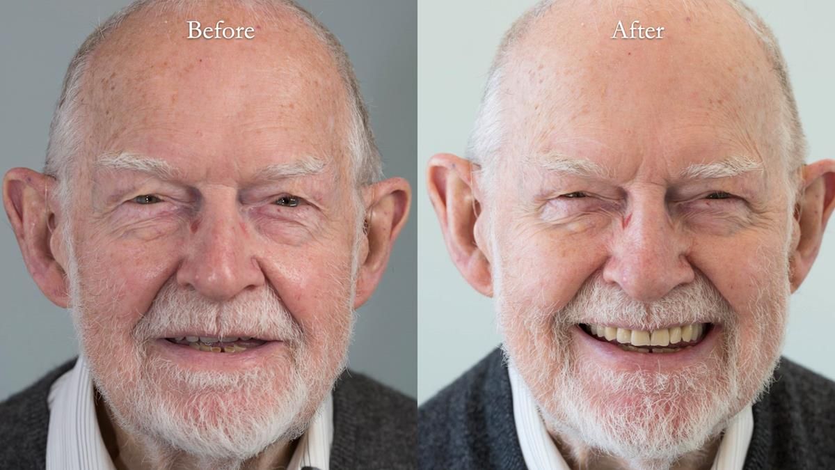 Newsletter 87 – Father Peter: A Partial Denture that needed Minor Miracle