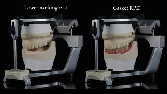 Newsletter 82 Mary - A complete upper and a one-tooth gasket denture