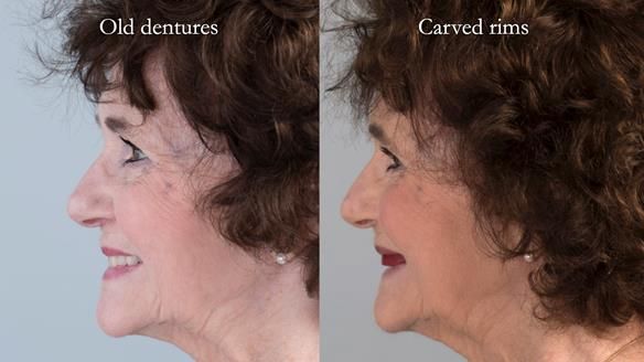 Newsletter 75: Marion’s case - Step-by-step complete denture workflow