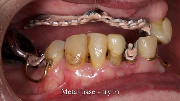 Newsletter 55 Provision of metal based partial dentures for Zephyrine with a repaired cleft lip and palate