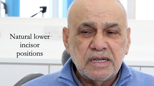 Managing poor implant positioning with complete dentures and Locator attachments - full protocol Newsletter 41