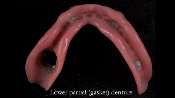 Newsletter 82 Mary - A complete upper and a one-tooth gasket denture