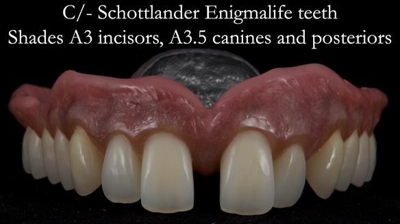 Newsletter 53 showing the making and fitting of ultra life-like dentures for Valena