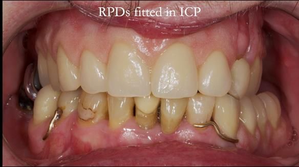 Newsletter 55 Provision of metal based partial dentures for Zephyrine with a repaired cleft lip and palate