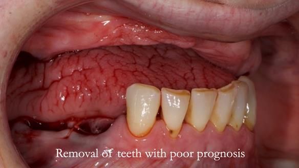 Newsletter 52 Managing Jo’s failing dentition with extractions and Mk 1/Mk 2 complete upper dentures and lower partial dentures FULL PROTOCOL