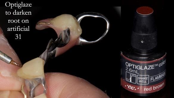 Newsletter 55 Provision of metal based partial dentures for Zephyrine with a repaired cleft lip and palate