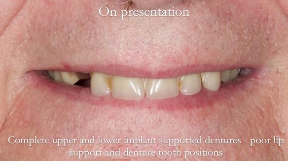 Newsletter 57 showcases the making and fitting process of implant-supported complete dentures for Alisdair