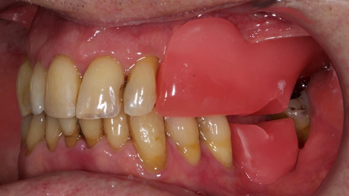 Newsletter 89 – Simon: A Challenging Kennedy Class II Division 1 Upper CoCr Partial Denture with a High Smile Line