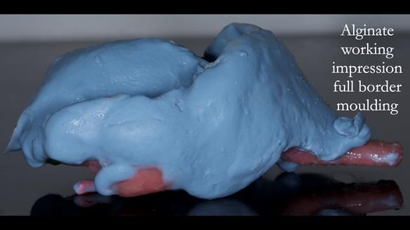 Newsletter 77: Jeremy’s case – immediate complete upper denture