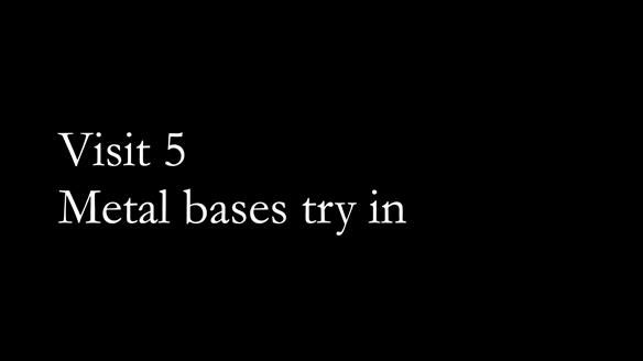 Newsletter 76: Jackie’s case – Telescopic overdenture & precision RPD (the tricky truth!)