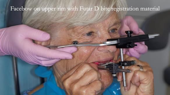 Eileen's transformation with upper and lower RPDs of Scandinavian hygienic design FULL PROTOCOL