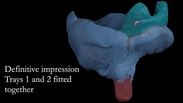 Upper metal base partial denture/occlusal stabilisation splint/obturator - full protocol