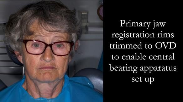 Solving Linda’s Failed “All on 4” implant bridges - full protocol Newsletter 42