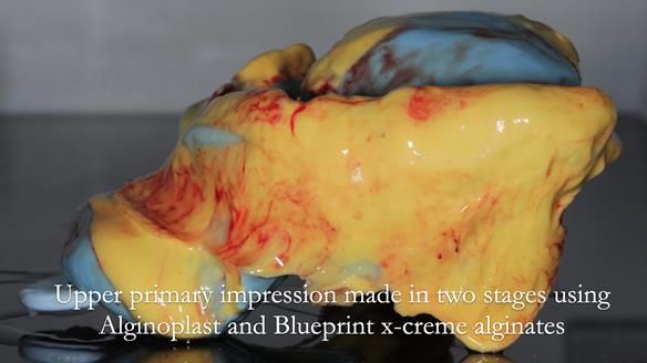 Finlay's Newsletter 62 provision of extractions and metal based complete dentures for Rafique