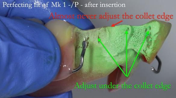 Newsletter 54 case presentation upper complete denture and lower Scandinavian designed hygienic partial denture for David